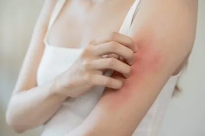 Asian woman has a rash possibly caused by a reaction to Biotin.
