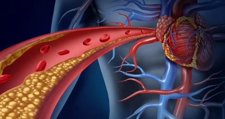 Young People More Vulnerable to Atherosclerosis Risk Factors